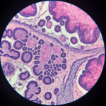 rak endometrium